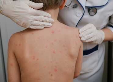 WHO’dan Kızamık Uyarısı: “Alarm Zilleri Çalıyor”  Vaka ve Ölüm Sayısı Kabul Edilemez Seviyede